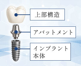 インプラント1本