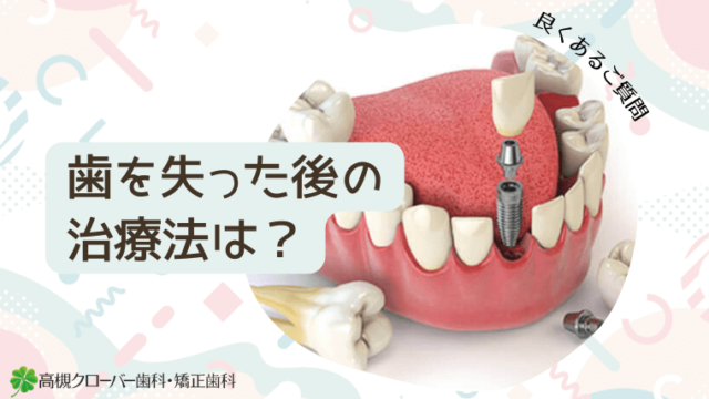 歯を失った後の治療法は？