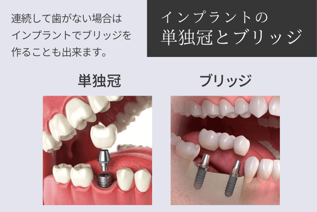 インプラントの単独冠とブリッジ