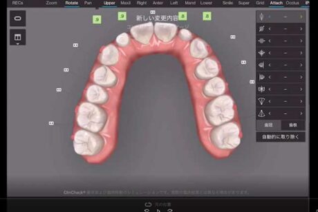 インビザラインのクリンチェック
