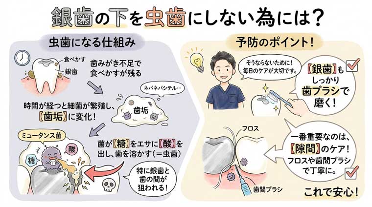 銀歯の下を虫歯にしない為には？の図解