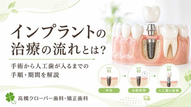 インプラント治療の流れとは？手術から人工歯が入るまでの手順・期間を解説