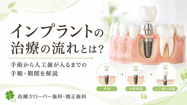 インプラント治療の流れとは？手術から人工歯が入るまでの手順・期間を解説