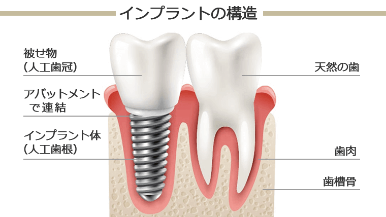 インプラントの構造