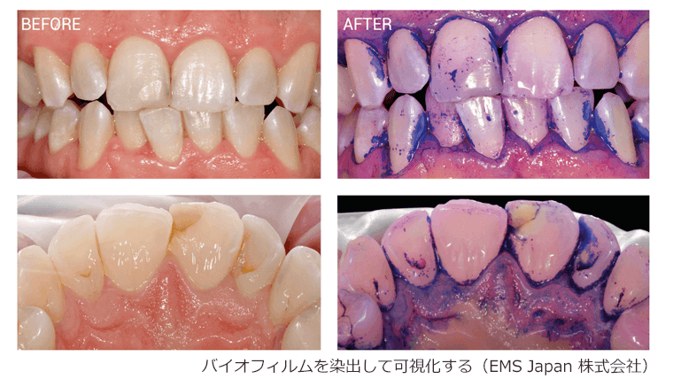 プラークコントロールには歯科でのメンテナンスが必要って本当？｜高槻