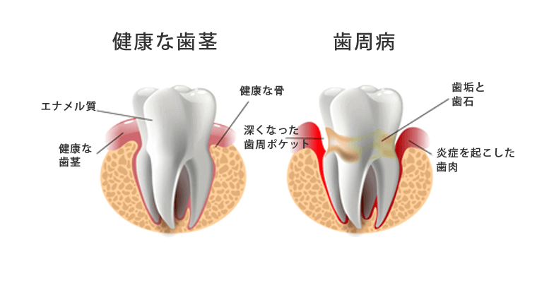 健康な歯と歯周病