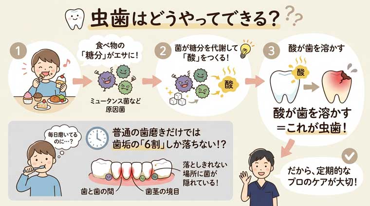 虫歯はどうやってできる？の図解