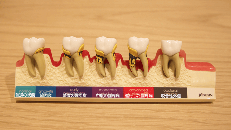 歯周病の進行模型