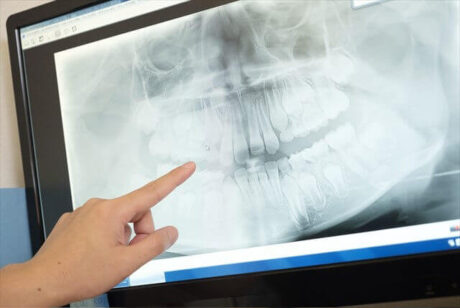 乳歯の生え変わりのレントゲン写真