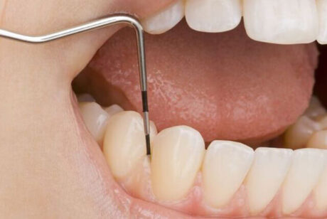 歯周ポケットの深さはどうやって測るの？｜高槻クローバー歯科よくあるご質問