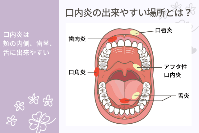 口内炎の出来やすい場所とは？