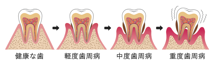 歯周病の進行