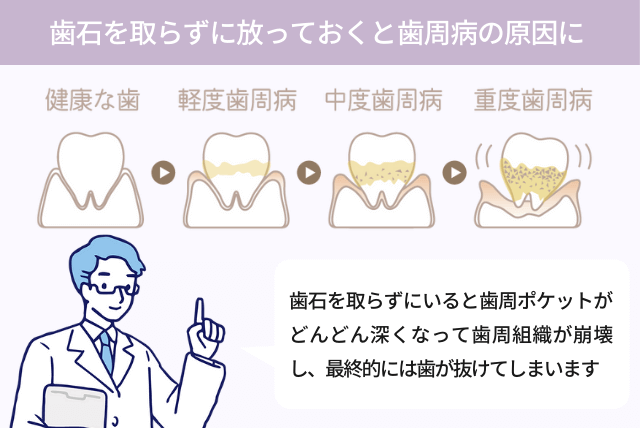 歯石を取らずに放っておくと歯周病の原因に