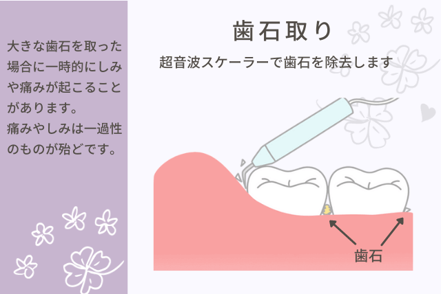 歯石取りの図