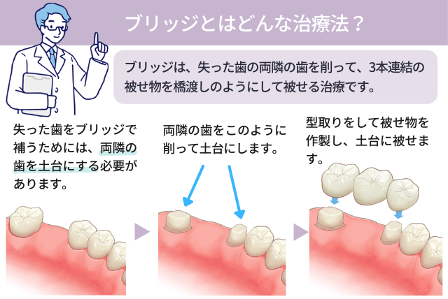 ブリッジとはどんな治療法？