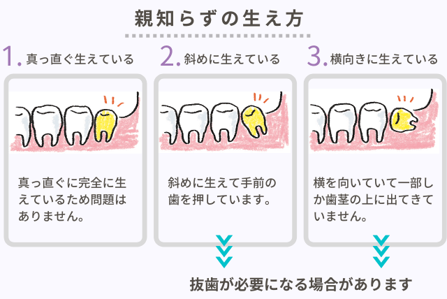 親知らずの生え方