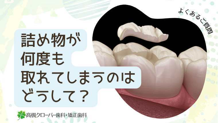 詰め物が何度も取れてしまうのはどうして？