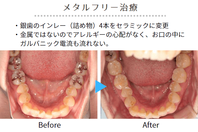 メタルフリー治療