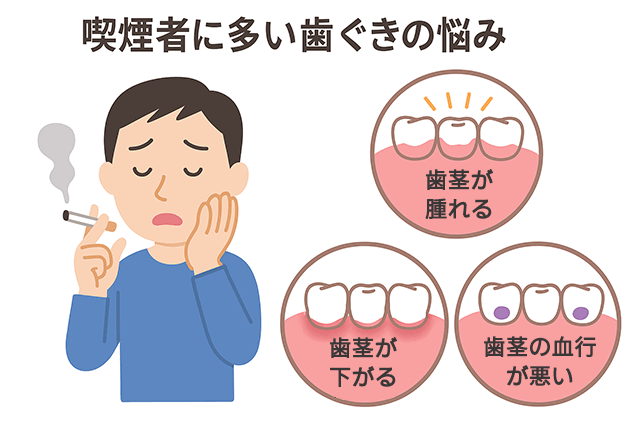 歯茎の悩み