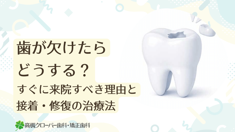 歯が欠けたらどうする？すぐに来院すべき理由と接着・修復の治療法
