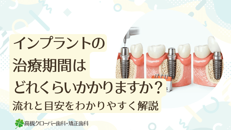 インプラント治療期間はどれくらいかかりますか？流れと目安をわかりやすく解説