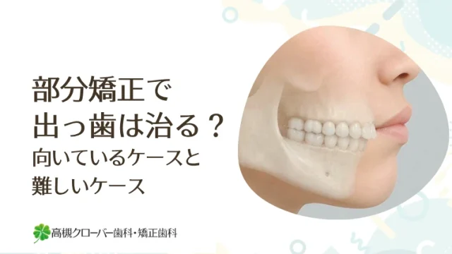 部分矯正で出っ歯は治る？向いているケースと難しいケース