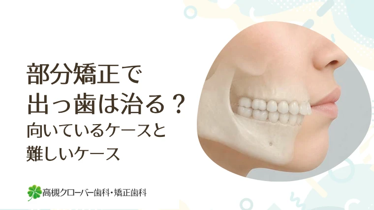 部分矯正で出っ歯は治る？向いているケースと難しいケース