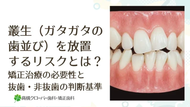 叢生（ガタガタの歯並び）を放置するリスクとは？矯正治療の必要性と抜歯・非抜歯の判断基準