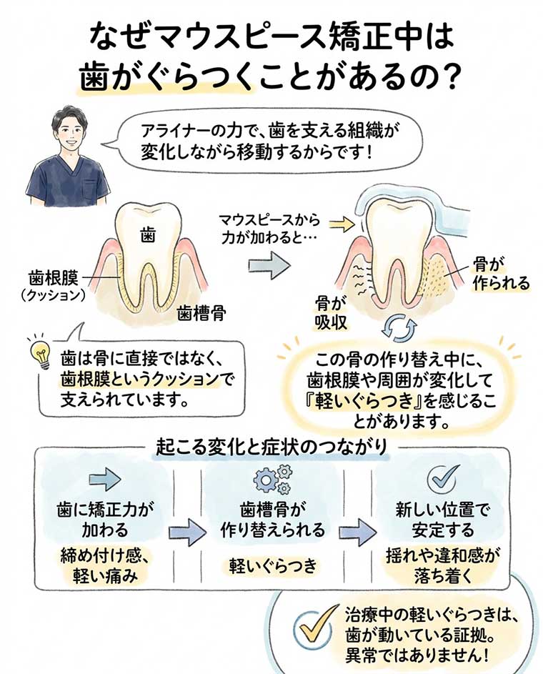 なぜマウスピース矯正中は歯がぐらつくことがあるの？の図解