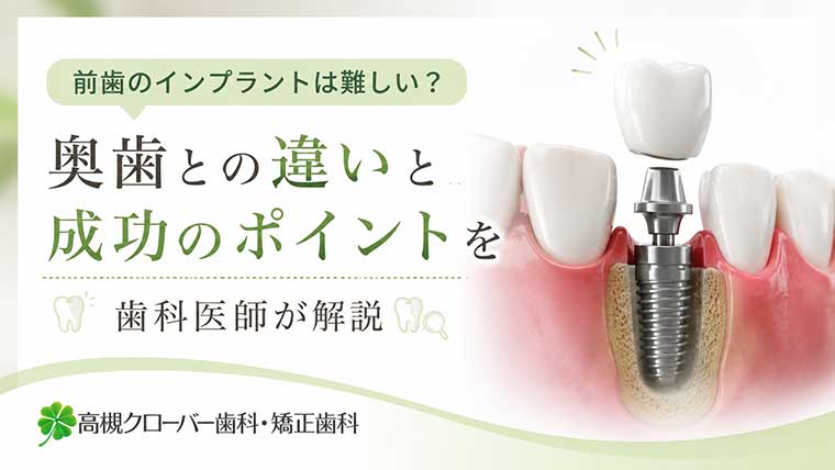 前歯のインプラントはなぜ難しいと言われるのでしょうか？奥歯との違いや難易度が高くなるケース、見た目を自然に仕上げるポイント、費用や治療期間、失敗を防ぐ方法まで歯科医師がわかりやすく解説します。