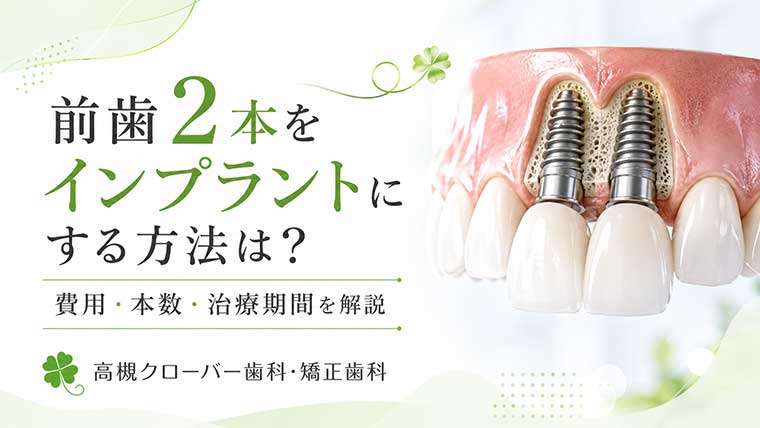 前歯2本をインプラントにする方法は？費用・本数・治療期間を解説