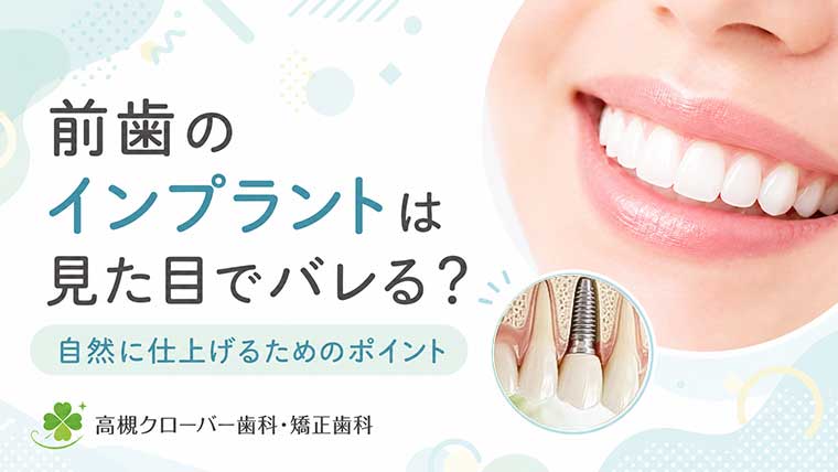 前歯のインプラントは見た目でバレる?自然に仕上げるためのポイント