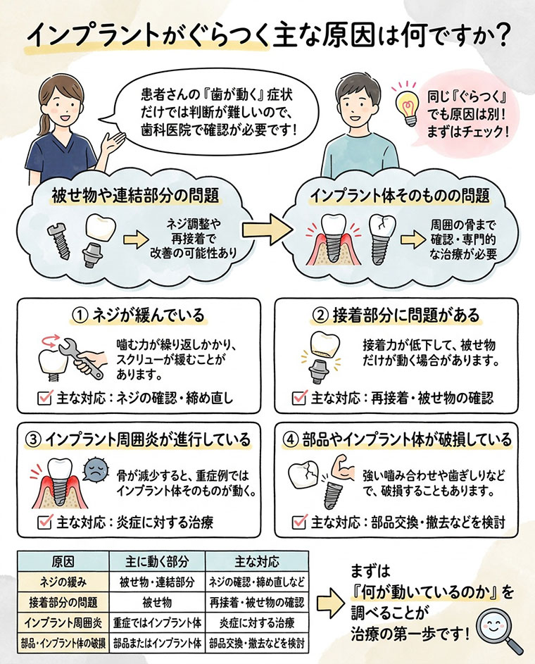 インプラントがぐらつく主な原因は何ですか？の図解